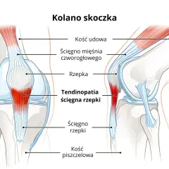 Ilustracja kolana skoczka pokazuje więzadła i ścięgna, w tym zapalenie ścięgna rzepki.
