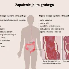 Bakteryjne zapalenie jelit: Objawy, których nie wolno lekceważyć