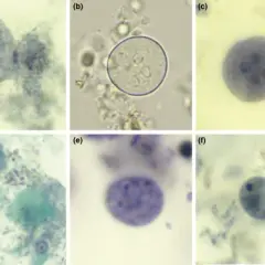 Entamoeba histolytica vs Endolimax nana: Objawy, leczenie
