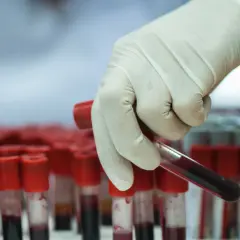 Ręka w rękawiczce pobiera probówkę z krwią do badań. Analiza CRP przy mononukleozie jest kluczowa.