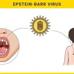 Wirus Epsteina-Barr - objawy i metody leczenia zakażenia