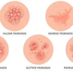 Ilustracja pokazuje różne rodzaje łuszczycy, w tym łuszczycę plackowatą, odwróconą, krostkową, kropelkowatą i erytrodermię łuszczycową. To pierwsze objawy tej choroby skóry.