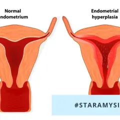 Przewlekłe zapalenie endometrium: objawy i metody leczenia.