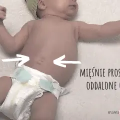 Rozejście mięśnia prostego brzucha u dziecka: objawy i leczenie.