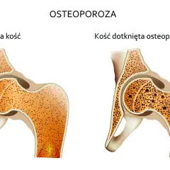 Osteoporoza przyczyny: Jak uniknąć utraty gęstości kości?