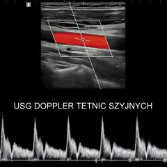 USG doppler tętnic szyjnych: obraz tętnicy z przepływem krwi (czerwony) i wykres prędkości przepływu.