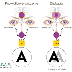 Podwójne widzenie przyczyny neurologiczne: co może je powodować?