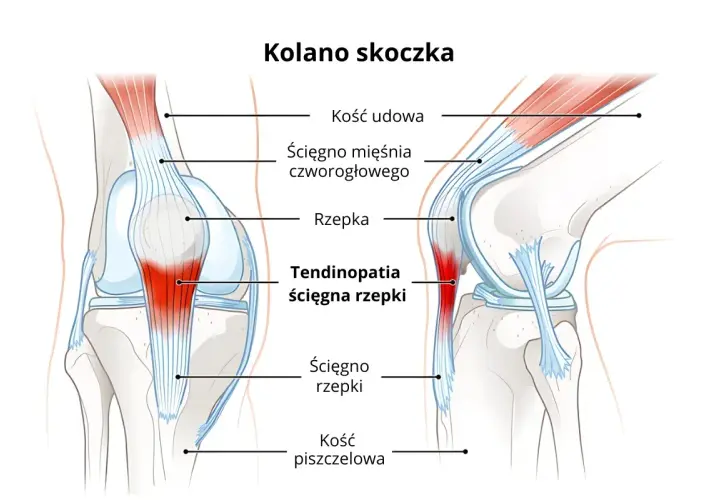 Ilustracja kolana skoczka pokazuje więzadła i ścięgna, w tym zapalenie ścięgna rzepki.