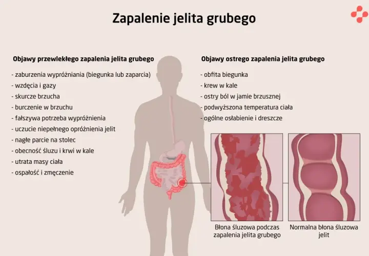 Bakteryjne zapalenie jelit: Objawy, których nie wolno lekceważyć