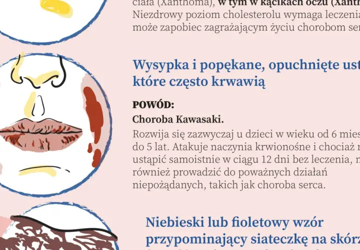 Ilustracja przedstawia twarz z wysypką i popękanymi ustami, objawy mogące wskazywać na najczęstsze choroby serca.