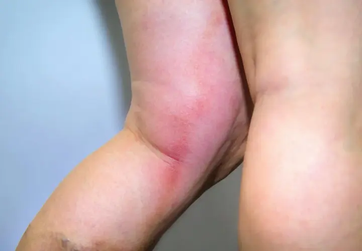 Obrzęk i zaczerwienienie nogi mogą być objawem zakrzepicy. Czy od zakrzepicy można umrzeć? Tak, jeśli nie zostanie szybko zdiagnozowana i leczona.