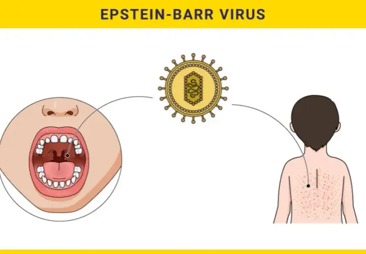 Wirus Epsteina-Barr - objawy i metody leczenia zakażenia