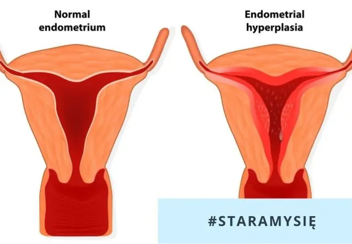 Przewlekłe zapalenie endometrium: objawy i metody leczenia.