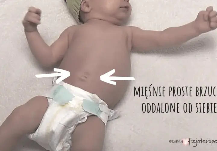 Rozejście mięśnia prostego brzucha u dziecka: objawy i leczenie.
