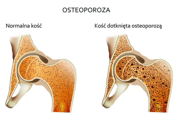 Osteoporoza przyczyny: Jak uniknąć utraty gęstości kości?