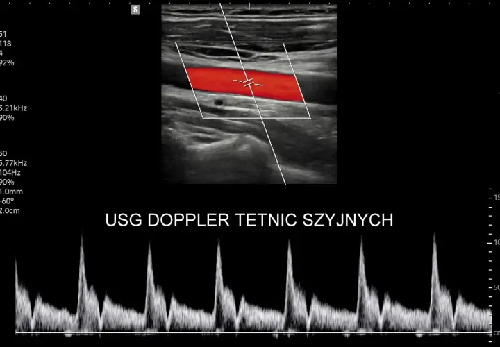 USG doppler tętnic szyjnych: obraz tętnicy z przepływem krwi (czerwony) i wykres prędkości przepływu.