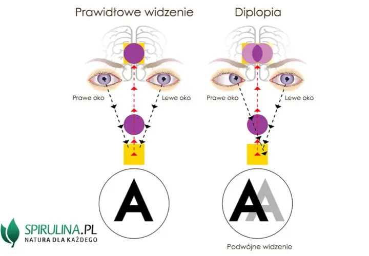Podwójne widzenie przyczyny neurologiczne: co może je powodować?