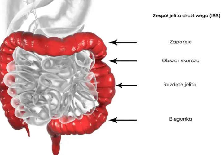Zespół jelita drażliwego: jakie badania są kluczowe dla diagnozy?