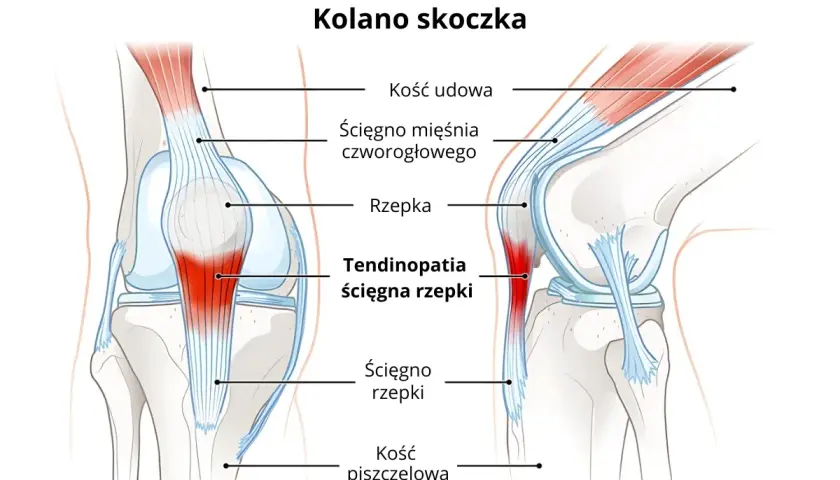 Ilustracja kolana skoczka pokazuje więzadła i ścięgna, w tym zapalenie ścięgna rzepki.