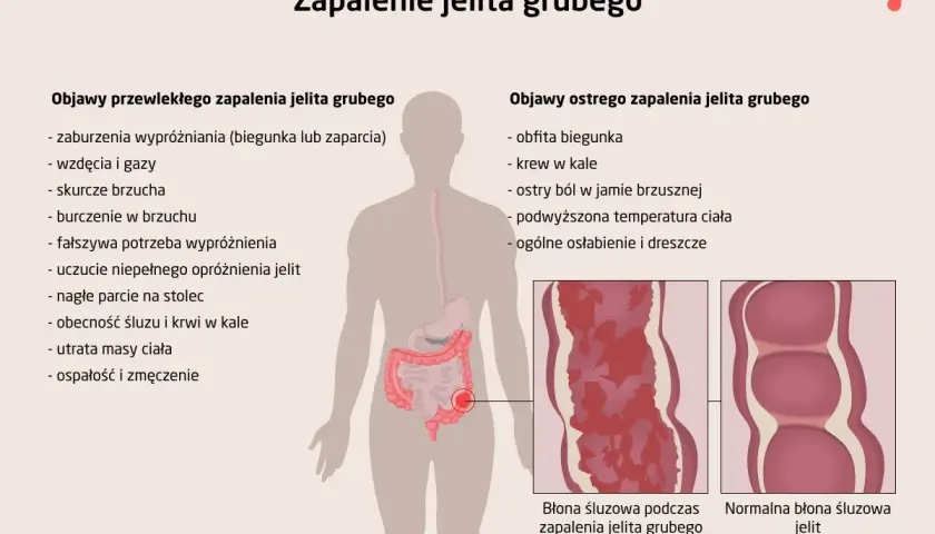 Bakteryjne zapalenie jelit: Objawy, których nie wolno lekceważyć