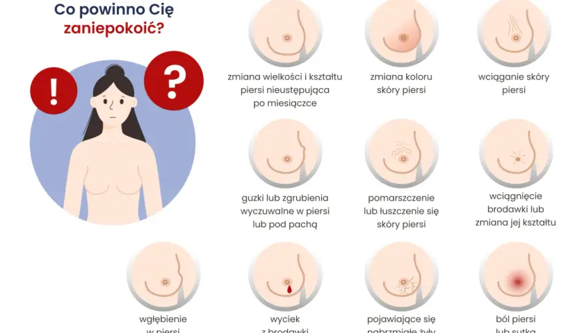 Ilustracja pokazuje objawy zapalnego raka sutka: zmiany skórne, guzki, wyciek z brodawki, ból.