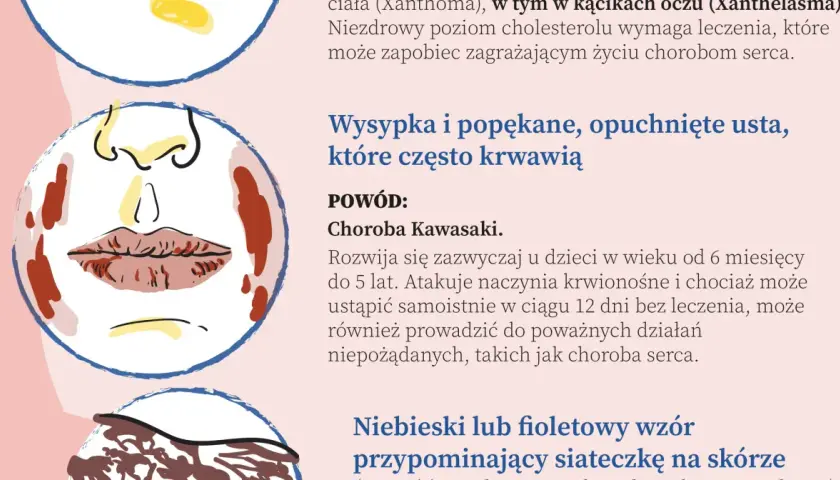 Ilustracja przedstawia twarz z wysypką i popękanymi ustami, objawy mogące wskazywać na najczęstsze choroby serca.
