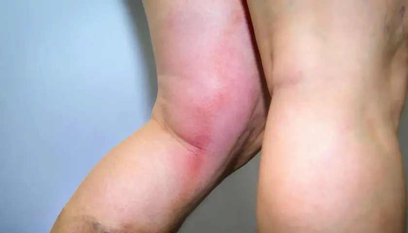 Obrzęk i zaczerwienienie nogi mogą być objawem zakrzepicy. Czy od zakrzepicy można umrzeć? Tak, jeśli nie zostanie szybko zdiagnozowana i leczona.