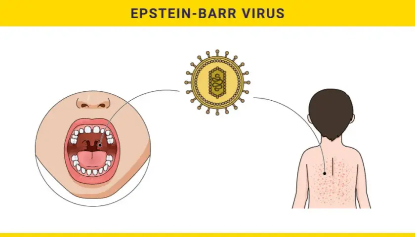 Wirus Epsteina-Barr - objawy i metody leczenia zakażenia