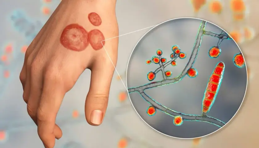 Grzybica: Znaczenie totalnej biologii w diagnozie i terapii