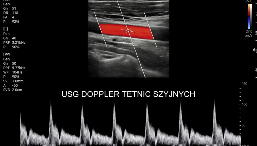 USG doppler tętnic szyjnych: obraz tętnicy z przepływem krwi (czerwony) i wykres prędkości przepływu.
