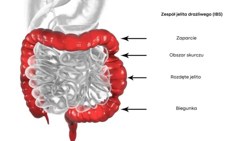 Zespół jelita drażliwego: jakie badania są kluczowe dla diagnozy?