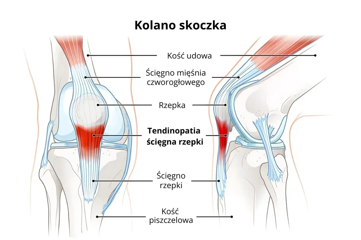Ilustracja kolana skoczka pokazuje więzadła i ścięgna, w tym zapalenie ścięgna rzepki.