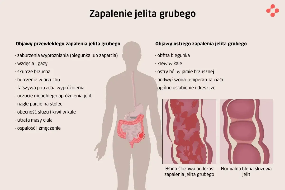 Bakteryjne zapalenie jelit: Objawy, których nie wolno lekceważyć