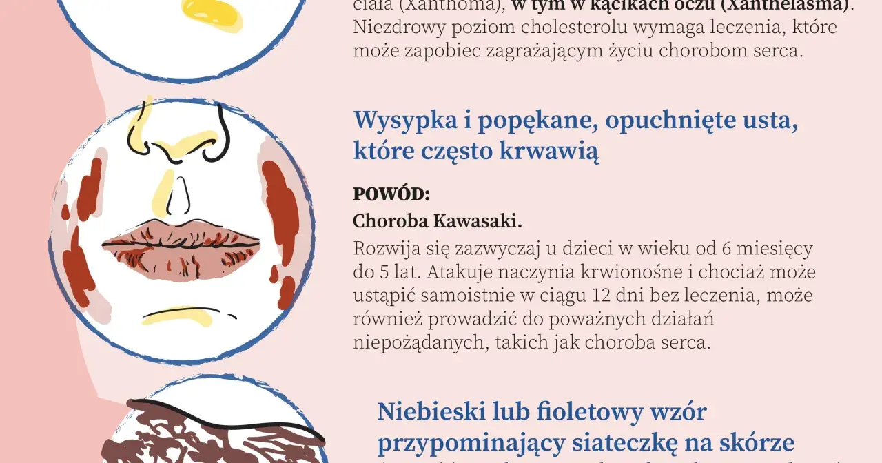 Ilustracja przedstawia twarz z wysypką i popękanymi ustami, objawy mogące wskazywać na najczęstsze choroby serca.