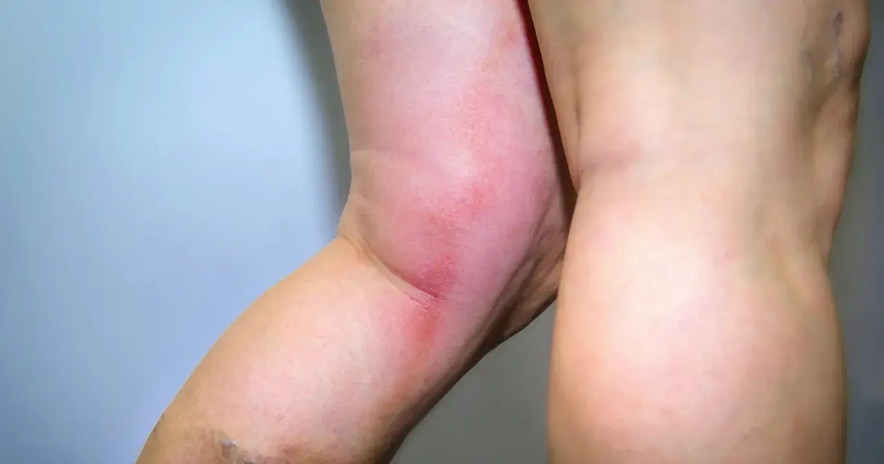 Obrzęk i zaczerwienienie nogi mogą być objawem zakrzepicy. Czy od zakrzepicy można umrzeć? Tak, jeśli nie zostanie szybko zdiagnozowana i leczona.