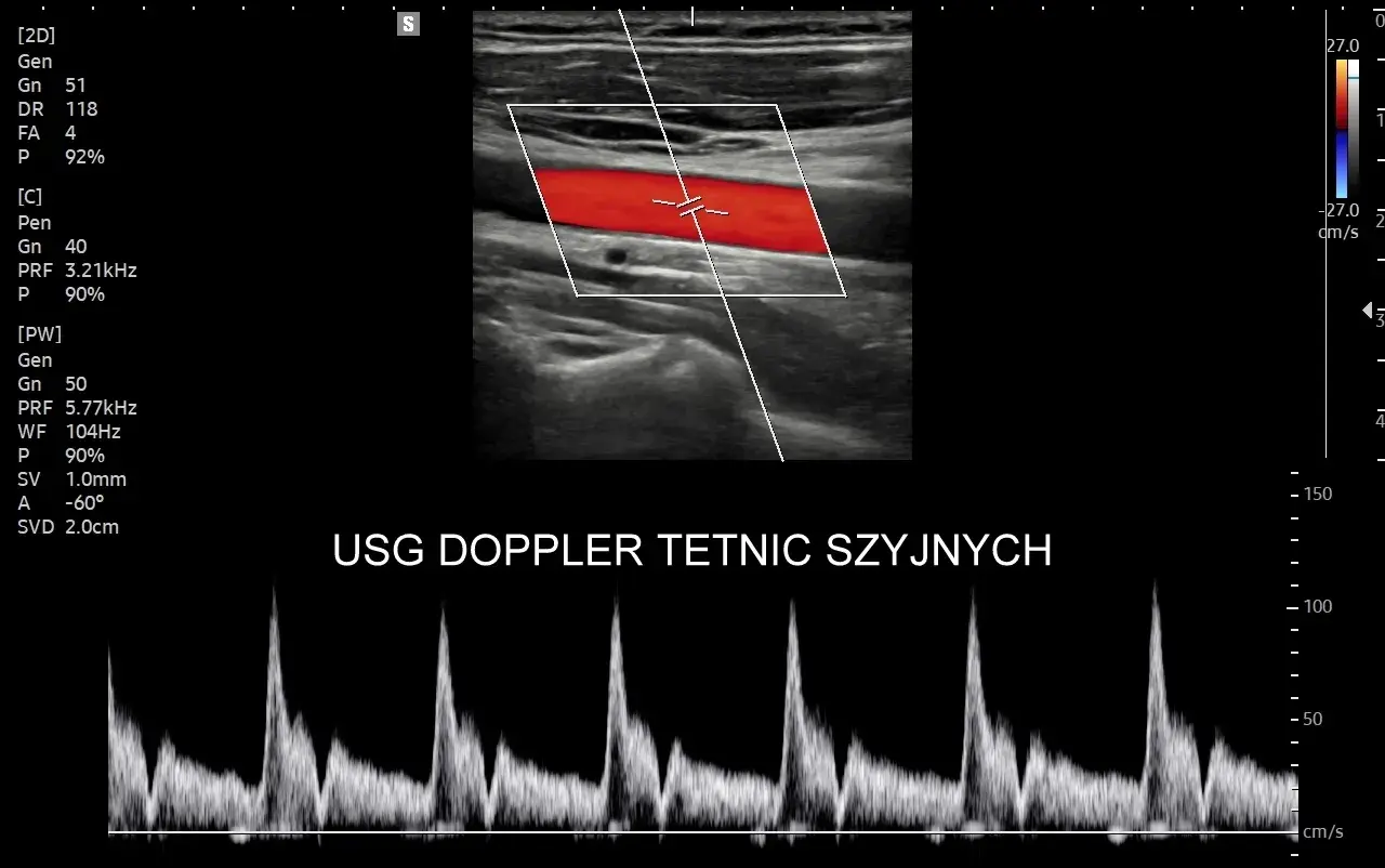 USG doppler tętnic szyjnych: obraz tętnicy z przepływem krwi (czerwony) i wykres prędkości przepływu.