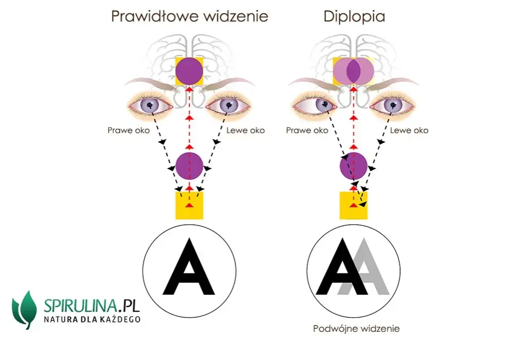 Podwójne widzenie przyczyny neurologiczne: co może je powodować?