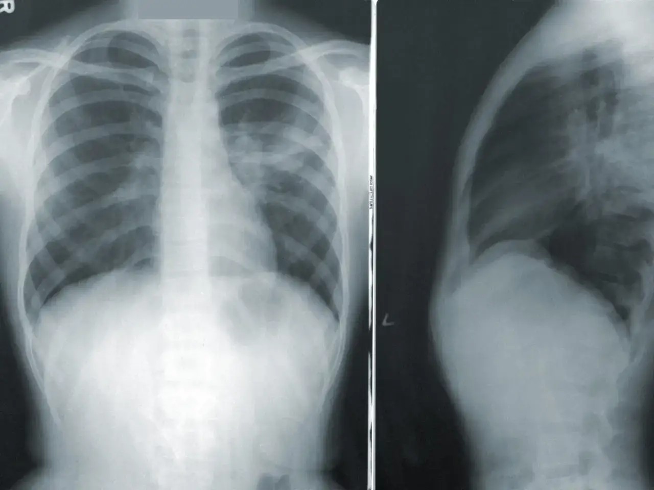 RTG klatki piersiowej z widocznymi zacienieniami sugerującymi zapalenie płuc. To obraz, który pomaga zrozumieć, pneumonia co to.