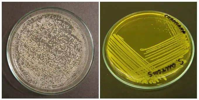 Zdjęcie Enterococcus faecalis w nasieniu: Jak leczyć tę bakterię?